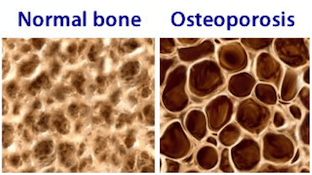 Osteoporosis-Bone-Scan-Promotion-effects